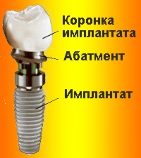 Импланты Implantium (Южная Корея)